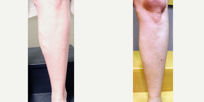 25-34 year old woman treated with VenaSeal - Treatment with VenaSeal Closure System.