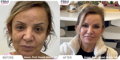 45-54 year old woman treated with Eyelid Surgery, Mini Facelift - 45-54 year old woman treated with Eyelid Surgery, Mini Facelift