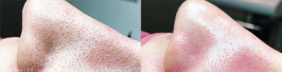 Woman treated with Facial - Woman treated with Dermalinfusion.