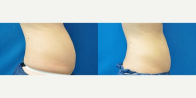 35-44 year old woman treated with Liposonix - 35-44 year old woman treated with Liposonix