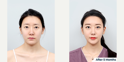 25-34 year old woman treated with V Line Surgery - DA Facial Contouring Surgery