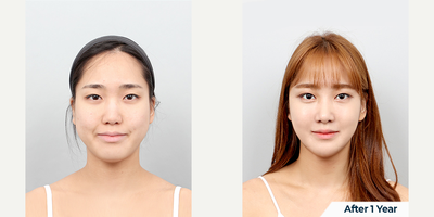 25-34 year old woman treated with V Line Surgery - DA 3 point Facial Contouring Surgery