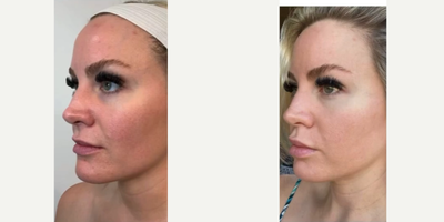 Jet Peel - Glowing, smoother skin after a JetPeel treatment
