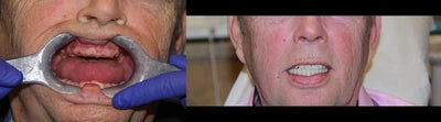 All-on-4 Dental Implants - The All-on-4 is the modern solution for all missing teeth. This treatment concept replaces your missing teeth with a Full Dental Bridge, No Palate, No Excess Material, Not Removable, and supported by only Four Specialty Dental Implants, with two of the Implants placed at precise angles. With less implants needed, overall treatment time is reduced. The unique All-on-4 solution also ensures greater stability in the bone, reducing the need for bone graft surgery to increase bone volume. Your teeth will look, feel and are brushed much like natural teeth, and you can lead a normal life immediately after a 1 Day surgery. Studies indicate that Patients receive 90-95% chewing ability.&nbsp;