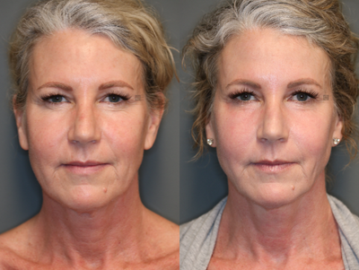 FaceTite - Non surgical neck tightening and lasers.