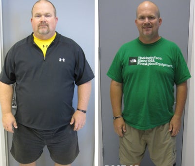 Before & After - 
	3 months post-op
