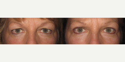 45-54 year old woman treated with Eyelid Surgery - Bilateral blepharoplasty