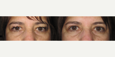 45-54 year old woman Double Eyelid Surgery - Bilateral blepharoplasty