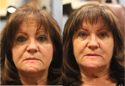 55-64 year old woman treated with Juvederm to scar on chin - Juvederm to scar on chin