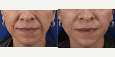 Restylane for smile lines around the mouth. Dermal fillers Los Angeles - 40 Something female patient felt she was looking tired because of the shadowing that was creeping in around the mouth.  One syringe of Restylane can make a big difference in the way we feel about our appearance.