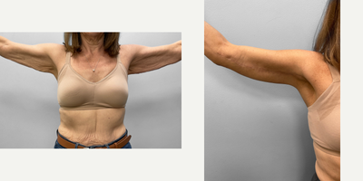 55-64 year old woman treated with Arm Lift - This woman in her early sixties was concerned about her sagging arm skin after weight loss. She met with Dr. Howell who described the process and realistic expectations and determined that she would be a good candidate for an arm lift (brachioplasty) without the need for liposuction. Shown before and six months afterwards she looks amazing and feels her results are life changing.