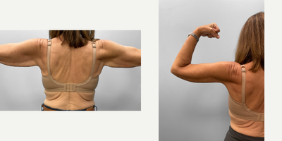 55-64 year old woman treated with Arm Lift - This woman in her early sixties was concerned about her sagging arm skin after weight loss. She met with Dr. Howell who described the process and realistic expectations and determined that she would be a good candidate for an arm lift (brachioplasty) without the need for liposuction. Shown before and six months afterwards she looks amazing and feels her results are life changing.