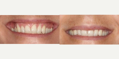 35-44 year old man treated with Lip Lowering - This patient's gummy smile was treated with upper lip lowering so the upper lip appears to be more full.