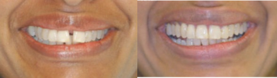 Adult Orthodontics with Six Month Smiles - 50 year old lady not satisfied with the gaps between front teeth. Patient was treated with clear braces. Treatment took 5 months.
