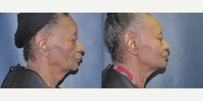 65 year old woman treated with Ultherapy - This 66 year-old patient was treated with Ultherapy of the full face and neck&nbsp;by Dr. Butler's RN.These photos were taken&nbsp;3 months following the treatment.
