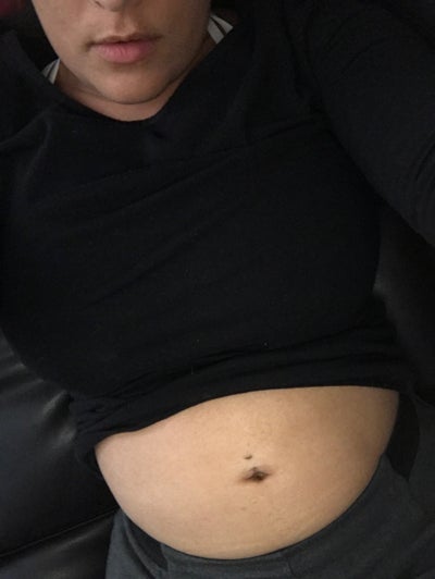 Unhappy Bbl By Dr Miami Michael Salzhauer Md Review Realself