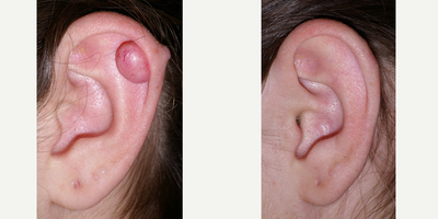 Removal of Keloid Scar on Ear - Keloid scar after ear piercing treated with surgical excision and Kenalog injections.