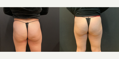 Woman treated with Aveli - Woman treated with Aveli