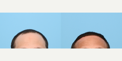25-34 year old man treated with Hair Loss Treatment, PRP for Hair Loss, Hair Transplant, FUE Hair Transplant, NeoGraft - One year after his FUE Hair Transplant with Dr. Wise, this 33-year-old patient is extremely happy with his new hairline and wishes hed done the procedure sooner. 2,240 grafts were transplanted in Zone 1 along with PRP therapy to obtain the results.