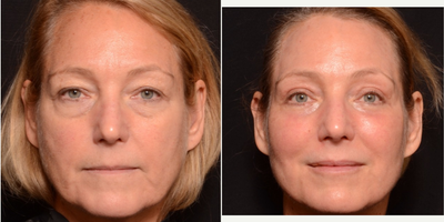 55-64 year old woman treated with Laser Resurfacing - Full Face Fractional Ablative Resurfacing Treatment with Bilateral Upper and Lower Eyelid Blepharoplasty