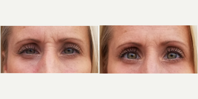 45-54 year old woman treated with Upneeq - 45-54 year old woman treated with Upneeq