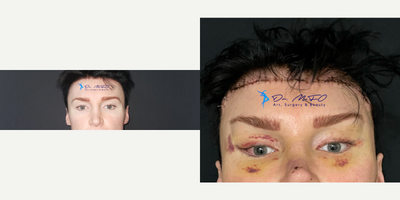 25-34 year old man treated with Canthoplasty - Facial Feminization surgery