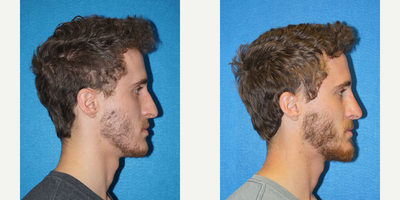 19 year old man treated with Revision Rhinoplasty - This is a 19 year-old male who is 63 tall. He presented to discuss improvements to his nose. He has had two previous rhinoplasty procedures. His initial rhinoplasty was to improve a large dorsal hump, make improvements to his nasal tip, and correct his septum for airway obstruction. The second surgery was to make revisions. He was still bothered by a prominent dorsum with a noticeable right-sided prominence. Therefore, a rhinoplasty was performed with a dorsal hump reduction as well as refining the right-sided prominence. In addition, the nasal tip was refined with a cephalic trim. Osteotomies and nasal bone infracture was also performed to further improve positioning of his dorsum.