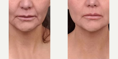 Woman treated with Profound RF - Woman treated with Profound RF