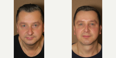 Man treated with Rhinoplasty - Man treated with Rhinoplasty