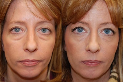 Lower eyelid rejuvenation with Silikon-1000 - 
	These photos demonstrate improvement of lower eyelid bags after a single treatment with Silikon-1000, an off-label filler for permanent results. She also had Botox to her glabella.&nbsp;
