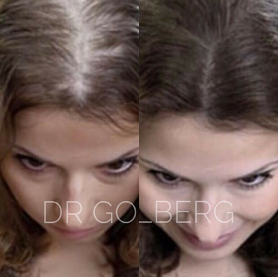 Woman treated with PRP Injections - Woman treated with PRP Injections