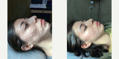 18-24 year old woman treated with Scar Removal Surgery - Taylor Liberator + Nokor needle subcision for deep acne scars