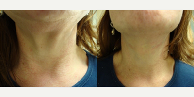Woman treated with Nonsurgical Neck Lift - Woman treated with Nonsurgical Neck Lift
