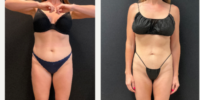 45-54 year old woman treated with Semaglutide - 20lbs weight loss on Semaglutide