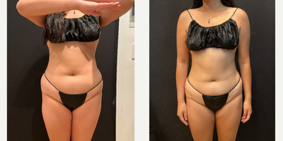 18-24 year old woman treated with Semaglutide - 40lbs weight loss with Semaglutide
