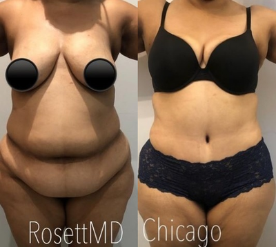 Woman treated with Tummy Tuck - Weeks after a tummy tuck with liposuction to her flanks and abdomen.