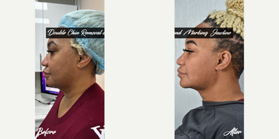 45-54 year old woman treated with Aqualyx, Botox, Kybella - i did double chin removal and marking jawline.