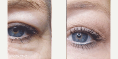 Woman treated with PlasmaPen - Woman treated with PlasmaPen