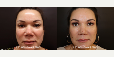 45-54 year old woman treated with Morpheus8 - Photos taken prior to first Morpheus8 treatment and after (3) treatments approximately 4 weeks apart. Results show overall facial/jawline slimming, improved under-eye skin and softening of the nasolabial folds.