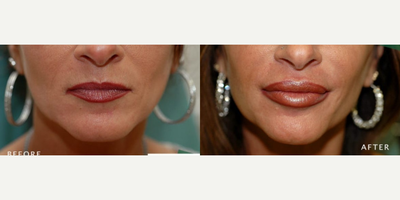 35-44 year old woman treated with Silikon 1000 - 35-44 year old woman treated with Silikon 1000