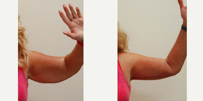 45-54 year old woman treated with Arm Lift - This woman in her 50s underwent a bilateral upper arm lift. Here she is shown 6 weeks after her operation.