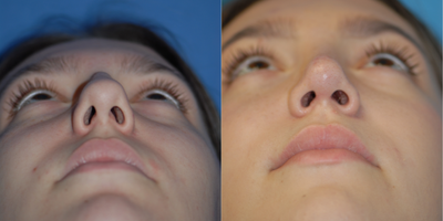 18-24 year old woman treated with Rhinoplasty - Base view shows the more triangular tip.