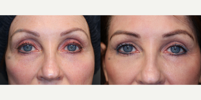 Fat transfer and laser resurfacing. - non-surgical eye rejuvenation with fat transfer and laser resurfacing.