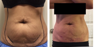Tickle Liposculpture and Renuvion (J Plasma) Skin Tightening Treatment  - Tickle Liposculpture combined with Renuvion(J Plasma) Skin Tightening