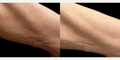Woman treated with Sylfirm X - Woman treated with Sylfirm X