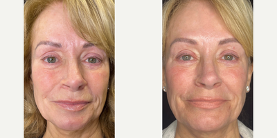 Woman treated with Sylfirm X - Woman treated with Sylfirm X