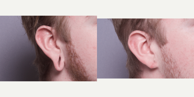 18-24 year old man treated with Ear Lobe Surgery - 18-24 year old man treated with Ear Lobe Surgery