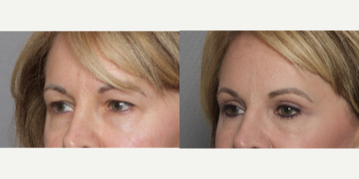 55-64 year old woman treated with Eyelid Surgery - 55-64 year old woman treated with Eyelid Surgery - Upper