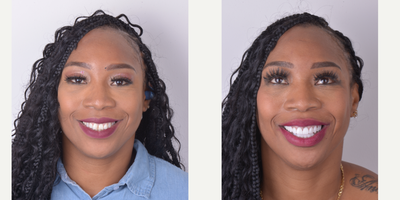 35-44 year old woman treated with Smile Makeover, Da Vinci Veneers, Lumineers - This patient improve her smile getting Veneers, now she looks more confidence and secure.Enjoy your new Smile!!!