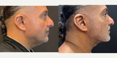 55-64 year old man treated with Nonsurgical Neck Lift - MyEllevate